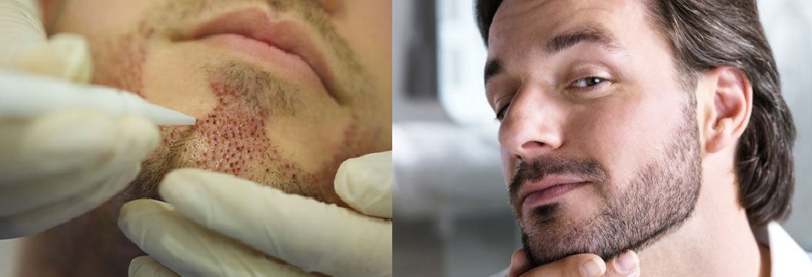 Résultats de greffe FUE de la barbe