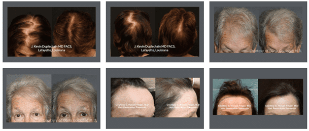Résultats des greffes de cheveux pour Femmes