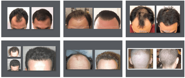 Résultats des greffes de cheveux pour Hommes